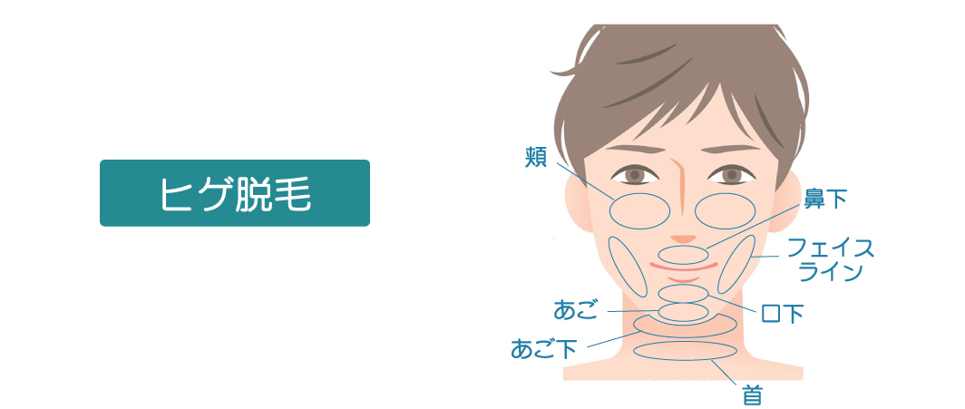 ひげ脱毛